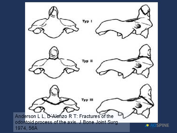 Anderson L L, D´Alonzo R T: Fractures of the odontoid process of the axis.