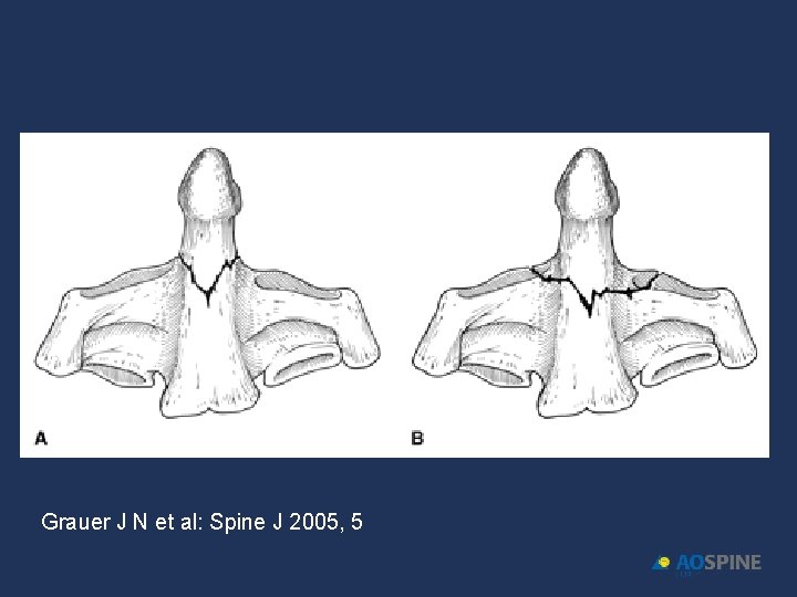 Grauer J N et al: Spine J 2005, 5 