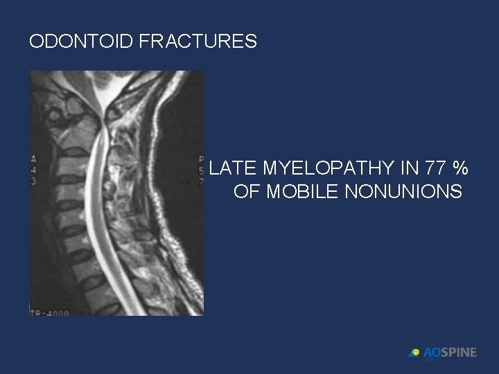 ODONTOID FRACTURES LATE MYELOPATHY IN 77 % OF MOBILE NONUNIONS 