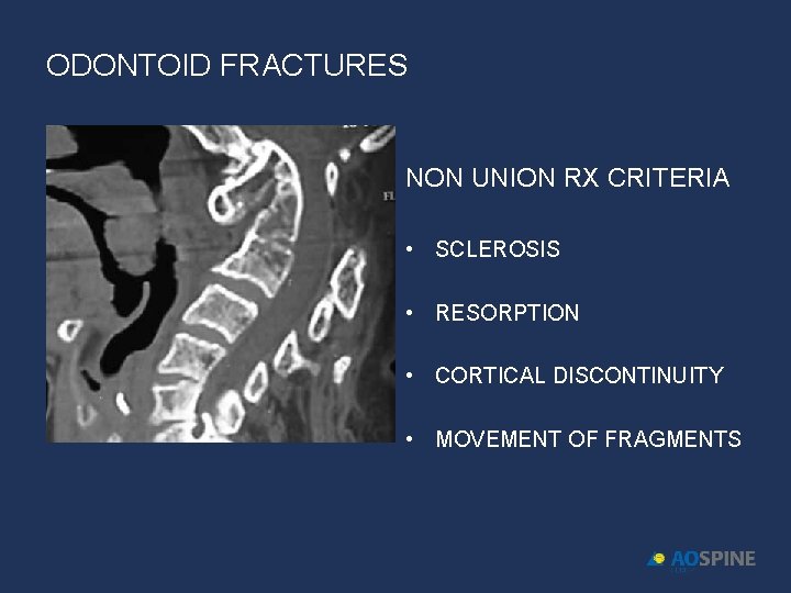 ODONTOID FRACTURES NON UNION RX CRITERIA • SCLEROSIS • RESORPTION • CORTICAL DISCONTINUITY •