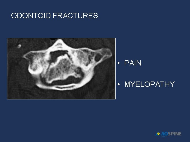 ODONTOID FRACTURES • PAIN • MYELOPATHY 