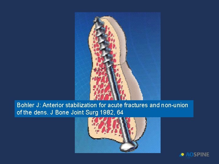 Bohler J: Anterior stabilization for acute fractures and non-union of the dens. J Bone