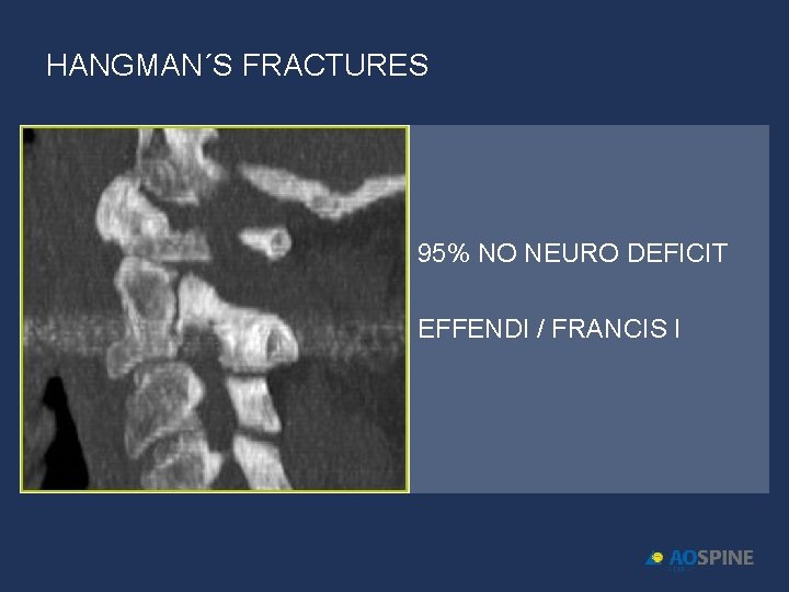 HANGMAN´S FRACTURES • 95% NO NEURO DEFICIT • EFFENDI / FRANCIS I 