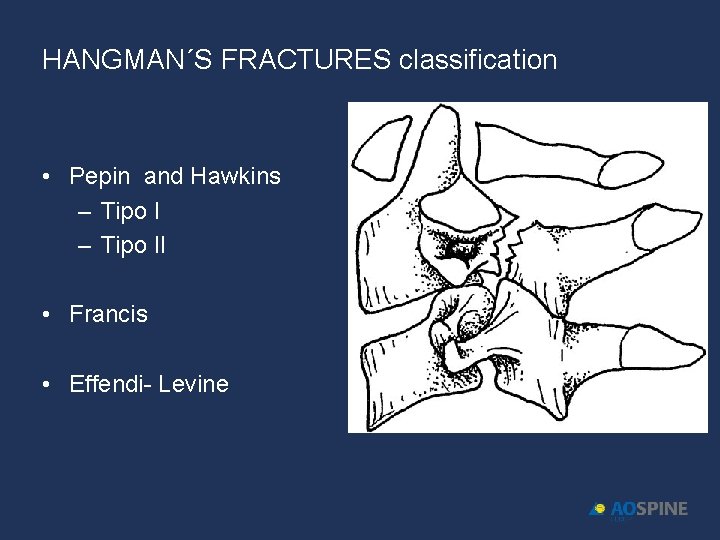 HANGMAN´S FRACTURES classification • Pepin and Hawkins – Tipo II • Francis • Effendi-