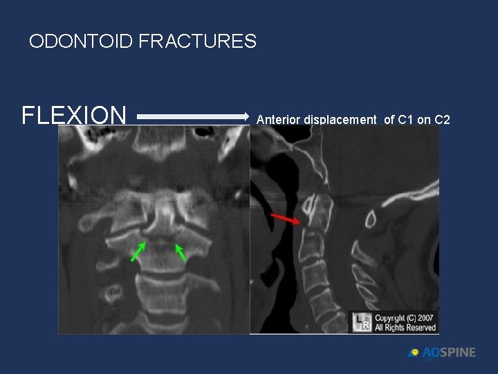 ODONTOID FRACTURES FLEXION Anterior displacement of C 1 on C 2 