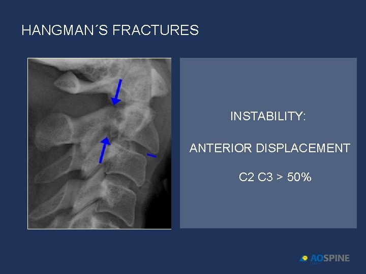 HANGMAN´S FRACTURES INSTABILITY: ANTERIOR DISPLACEMENT C 2 C 3 > 50% 