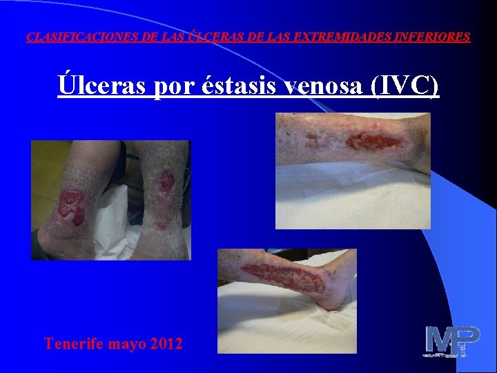 CLASIFICACIONES DE LAS ÚLCERAS DE LAS EXTREMIDADES INFERIORES Úlceras por éstasis venosa (IVC) Tenerife