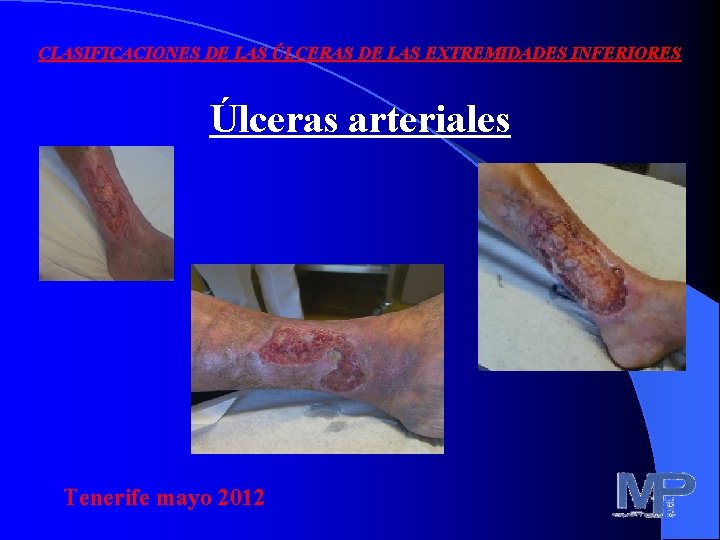 CLASIFICACIONES DE LAS ÚLCERAS DE LAS EXTREMIDADES INFERIORES Úlceras arteriales Tenerife mayo 2012 