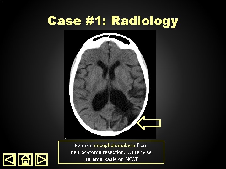 Case #1: Radiology Remote encephalomalacia from neurocytoma resection. Otherwise unremarkable on NCCT 