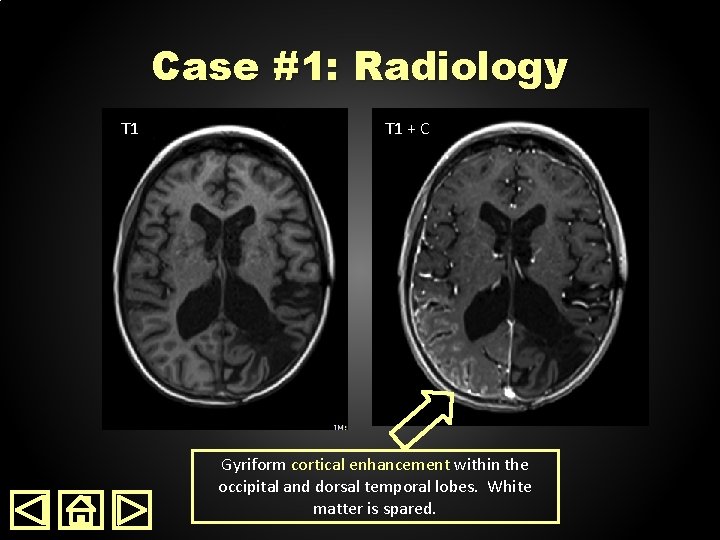 Case #1: Radiology T 1 + C Gyriform cortical enhancement within the occipital and