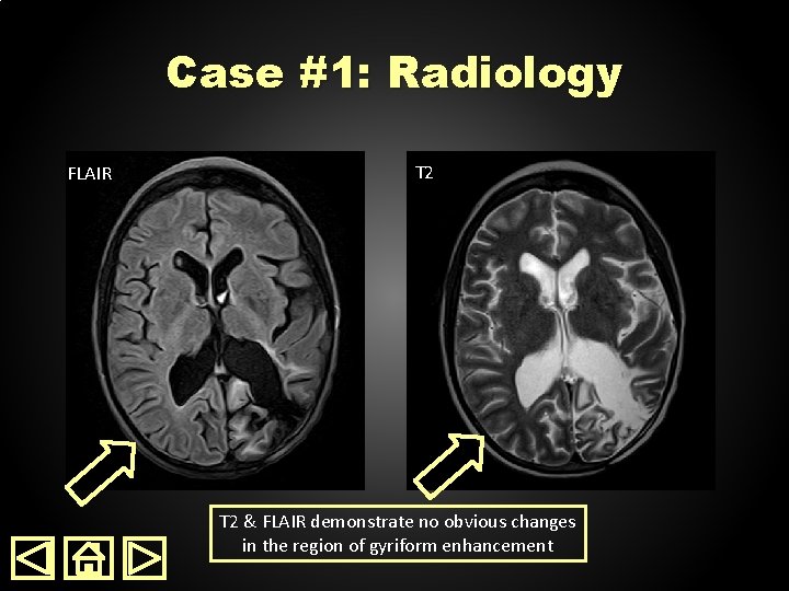Case #1: Radiology FLAIR T 2 & FLAIR demonstrate no obvious changes in the