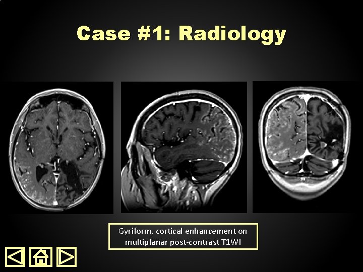 Case #1: Radiology Gyriform, cortical enhancement on multiplanar post-contrast T 1 WI 