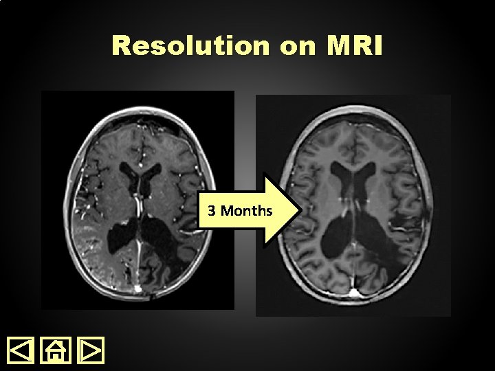 Resolution on MRI 3 Months 