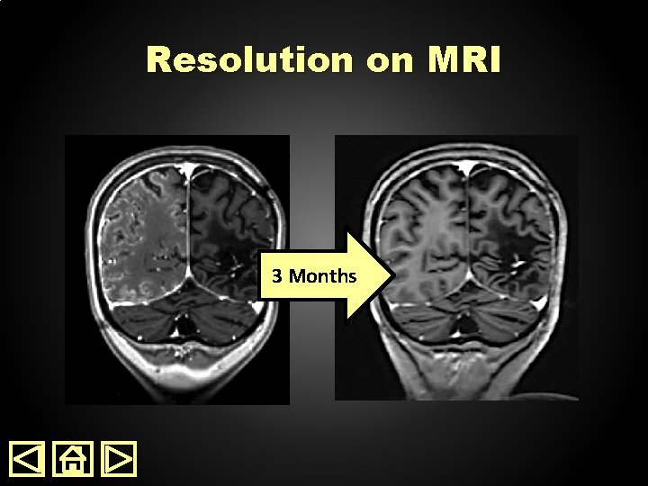 Resolution on MRI 3 Months 