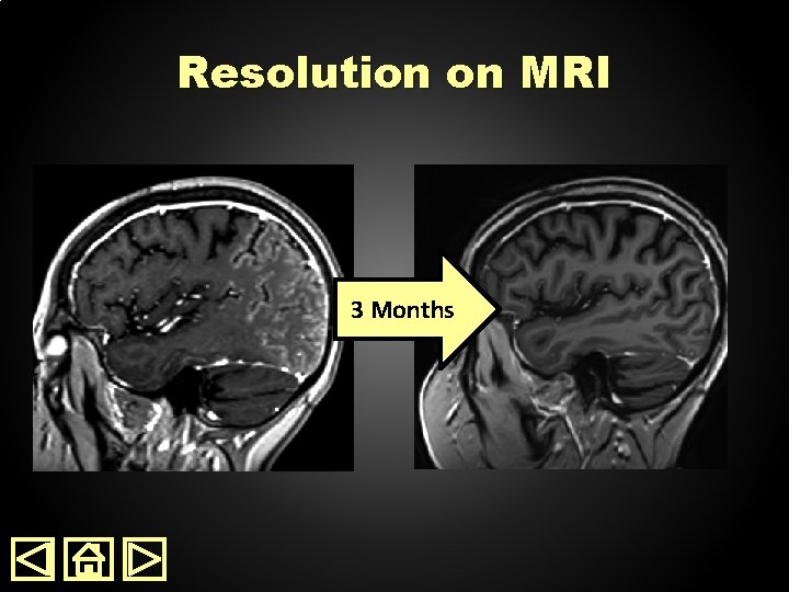 Resolution on MRI 3 Months 