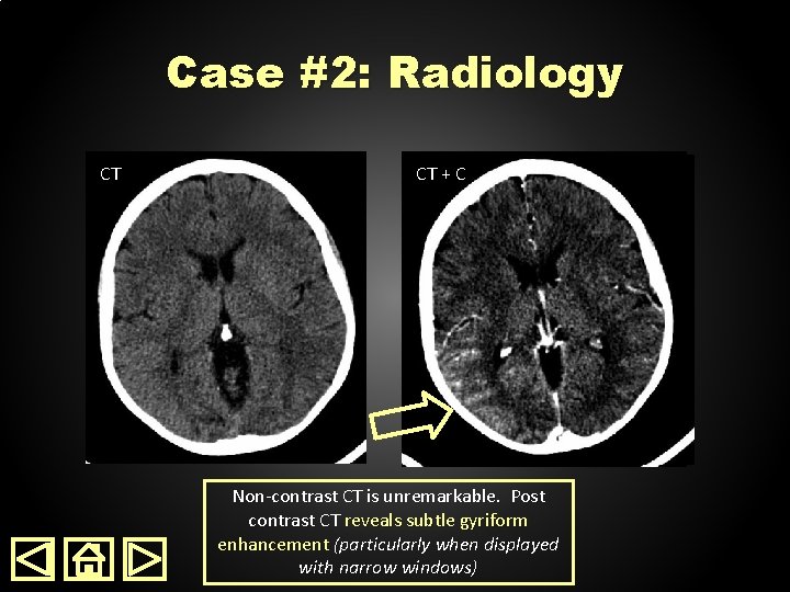 Case #2: Radiology CT CT + C Non-contrast CT is unremarkable. Post contrast CT