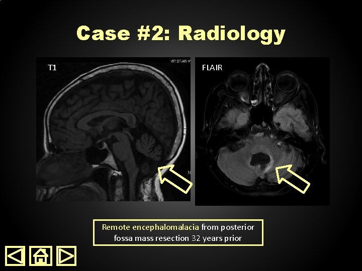 Case #2: Radiology T 1 FLAIR Remote encephalomalacia from posterior fossa mass resection 32