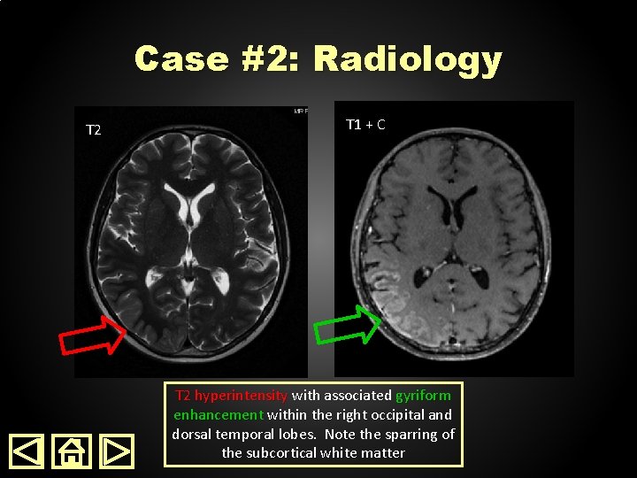 Case #2: Radiology T 2 T 1 + C T 2 hyperintensity with associated