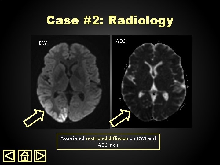 Case #2: Radiology DWI ADC Associated restricted diffusion on DWI and ADC map 