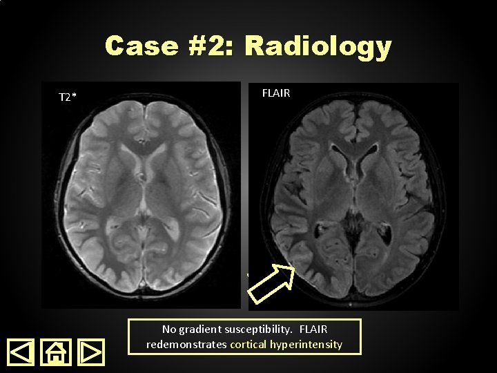 Case #2: Radiology T 2* FLAIR No gradient susceptibility. FLAIR redemonstrates cortical hyperintensity 