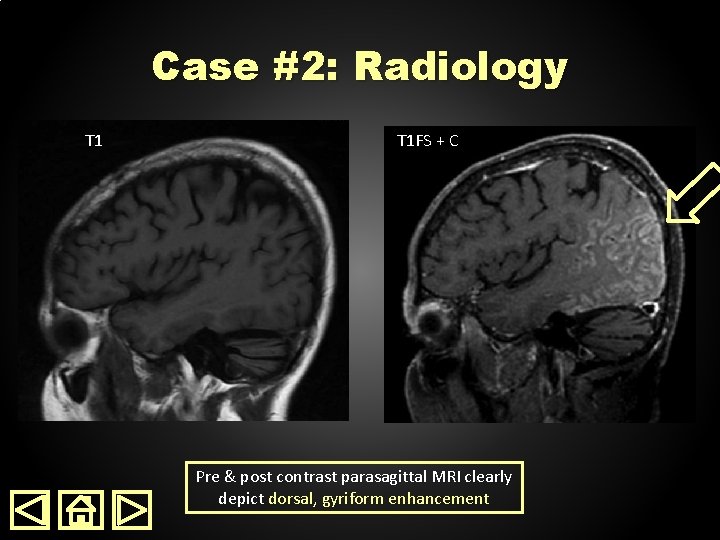 Case #2: Radiology T 1 FS + C Pre & post contrast parasagittal MRI