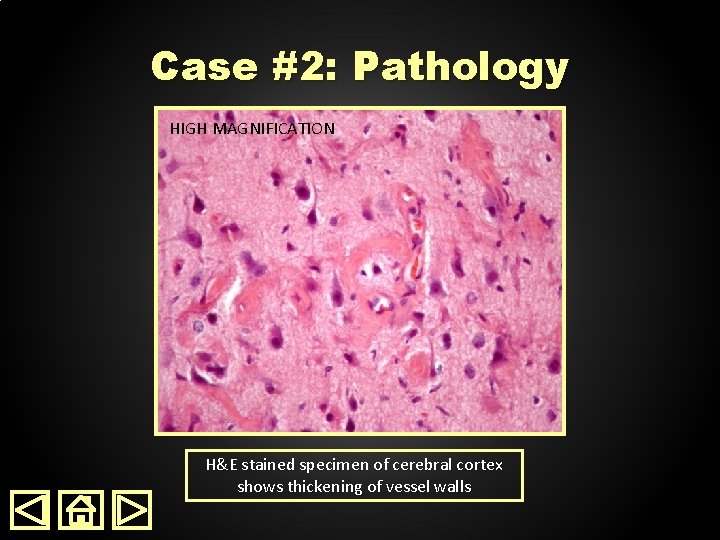 Case #2: Pathology HIGH LOWMAGNIFICATION H&E stained specimen of cerebral cortex shows thickening of