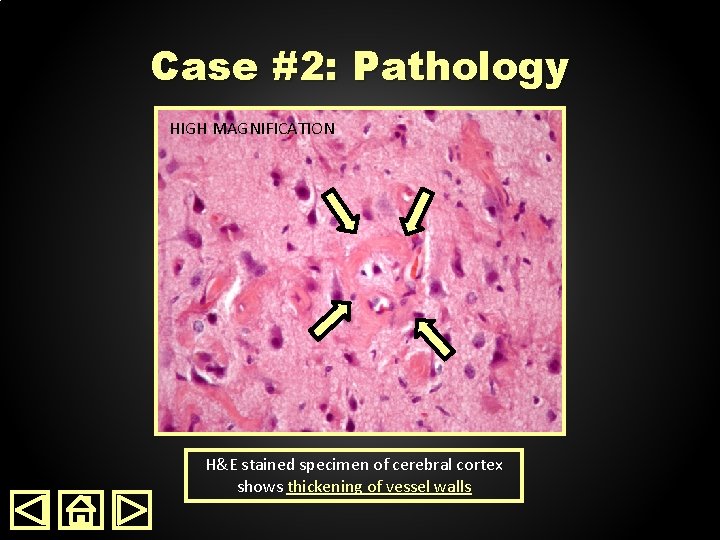Case #2: Pathology HIGH LOWMAGNIFICATION H&E stained specimen of cerebral cortex shows thickening of