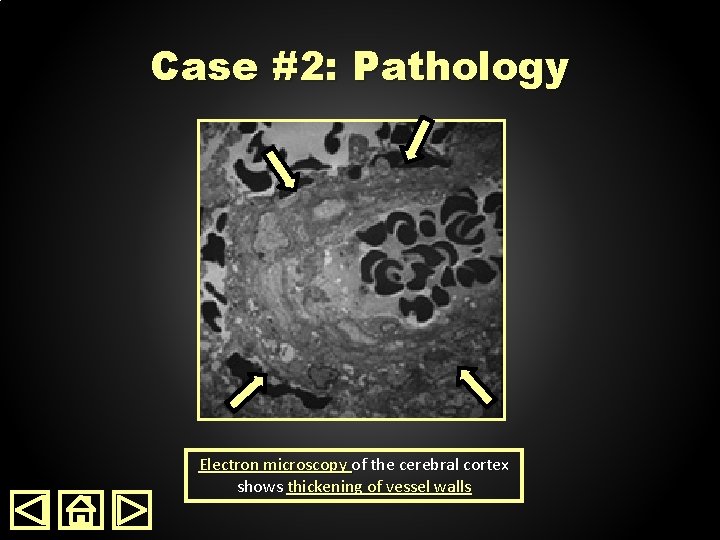 Case #2: Pathology Electron microscopy of the cerebral cortex shows thickening of vessel walls