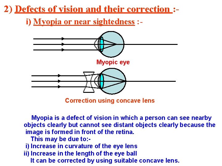 2) Defects of vision and their correction : i) Myopia or near sightedness :