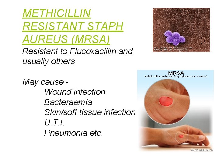 METHICILLIN RESISTANT STAPH AUREUS (MRSA) Resistant to Flucoxacillin and usually others May cause Wound