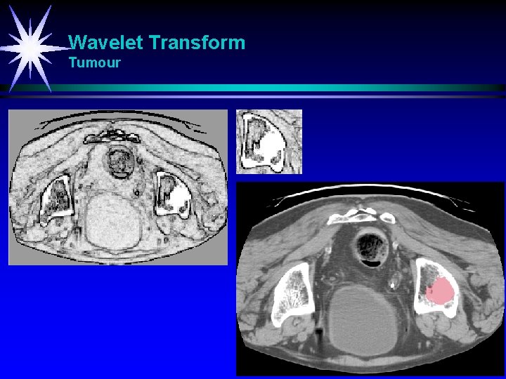 Wavelet Transform Tumour 
