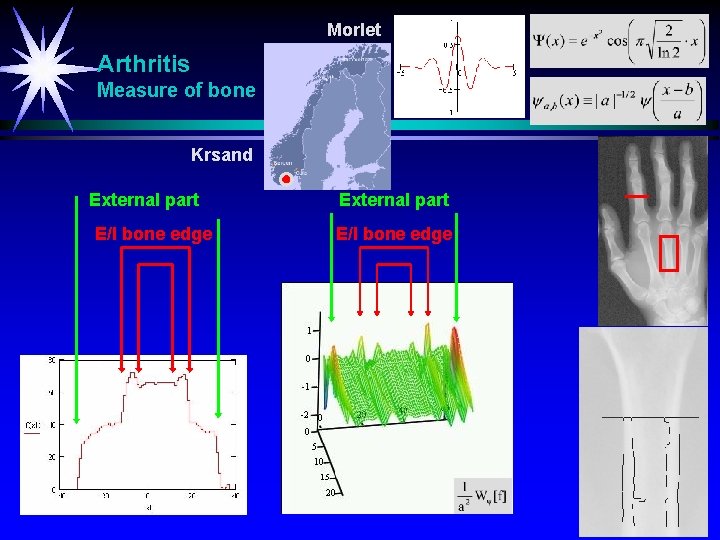 Morlet Arthritis Measure of bone Krsand External part E/I bone edge 