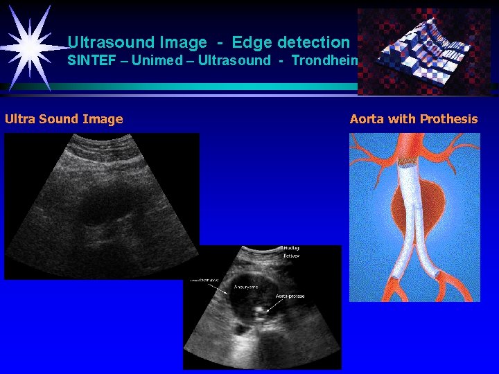 Ultrasound Image - Edge detection SINTEF – Unimed – Ultrasound - Trondheim Ultra Sound