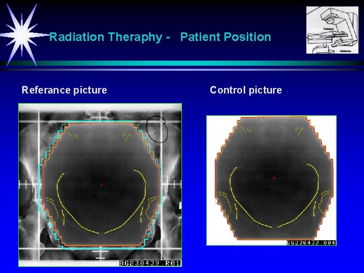 Radiation Theraphy - Patient Position Referance picture Control picture 