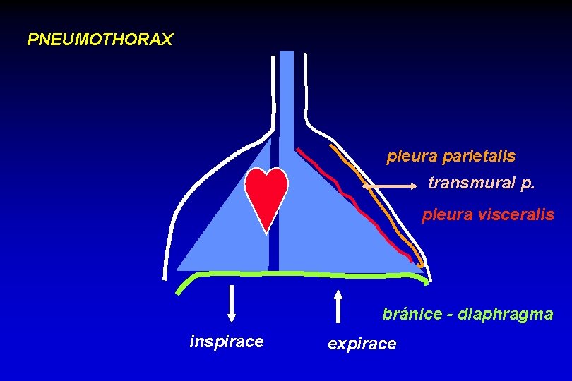 PNEUMOTHORAX pleura parietalis transmural p. pleura visceralis bránice - diaphragma inspirace expirace 