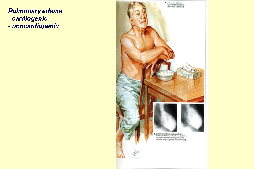 Pulmonary edema - cardiogenic - noncardiogenic 