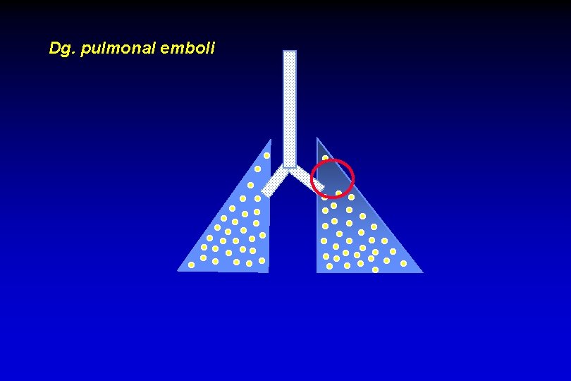 Dg. pulmonal emboli 