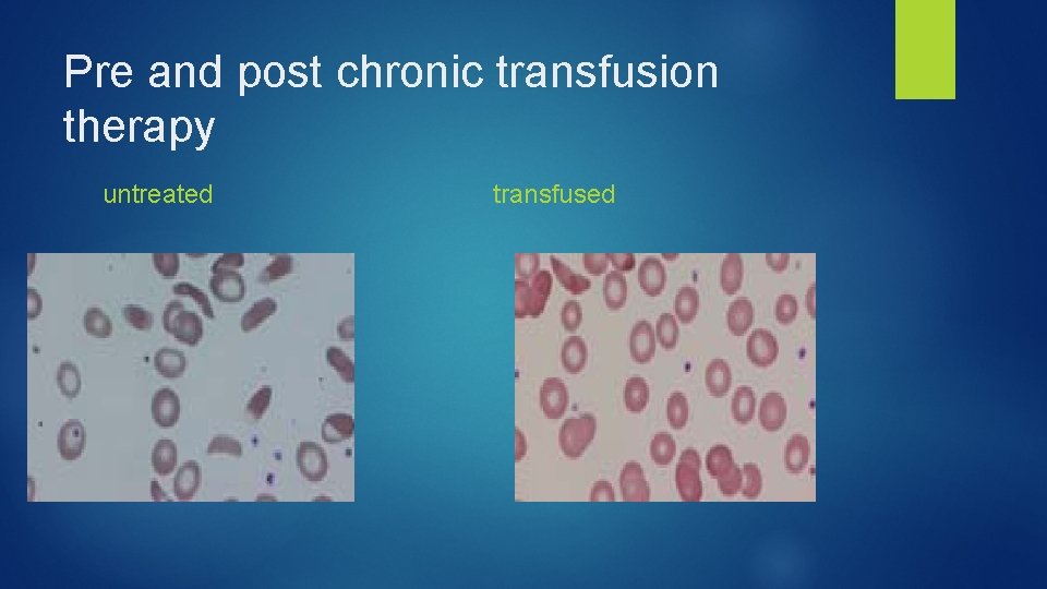 Pre and post chronic transfusion therapy untreated transfused 