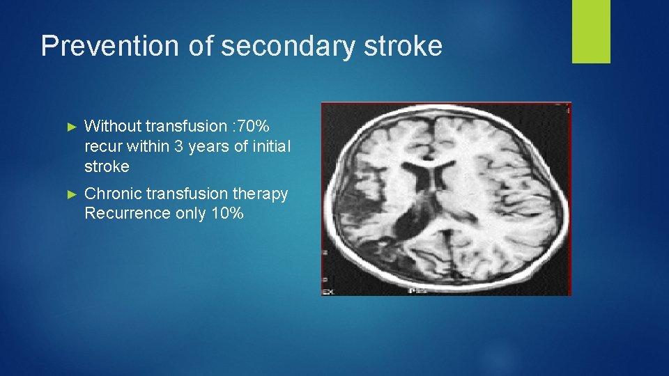 Prevention of secondary stroke ► Without transfusion : 70% recur within 3 years of
