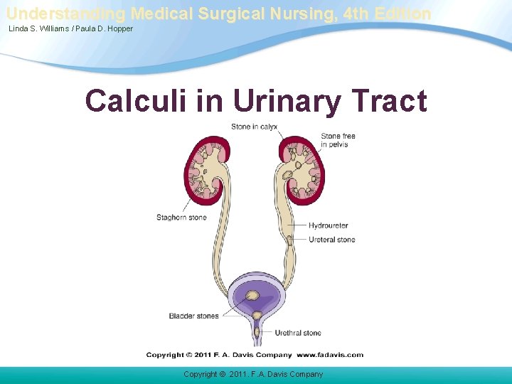 Understanding Medical Surgical Nursing, 4 th Edition Linda S. Williams / Paula D. Hopper Understanding Medical Surgical Nursing, 4 th Edition Linda S. Williams / Paula D. Hopper