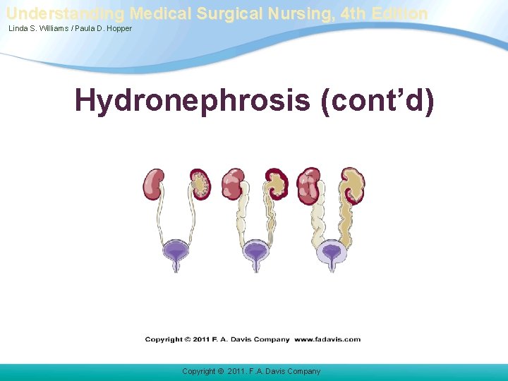 Understanding Medical Surgical Nursing, 4 th Edition Linda S. Williams / Paula D. Hopper Understanding Medical Surgical Nursing, 4 th Edition Linda S. Williams / Paula D. Hopper