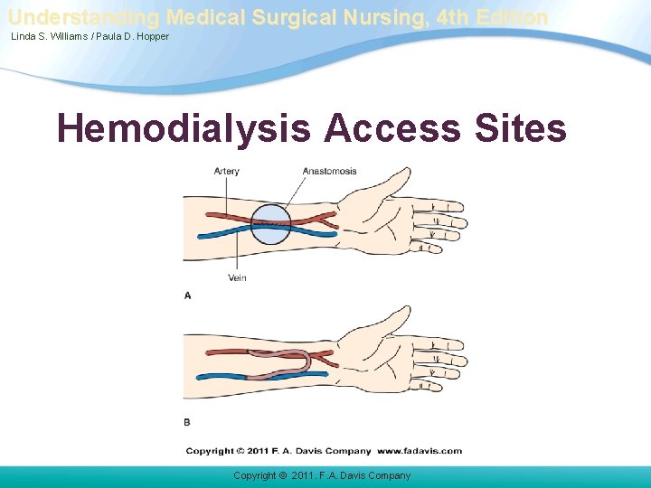 Understanding Medical Surgical Nursing, 4 th Edition Linda S. Williams / Paula D. Hopper Understanding Medical Surgical Nursing, 4 th Edition Linda S. Williams / Paula D. Hopper