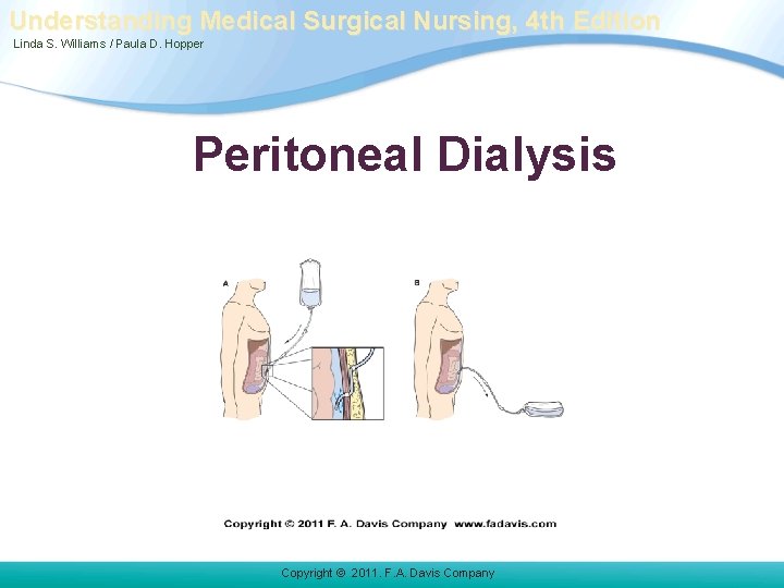 Understanding Medical Surgical Nursing, 4 th Edition Linda S. Williams / Paula D. Hopper Understanding Medical Surgical Nursing, 4 th Edition Linda S. Williams / Paula D. Hopper