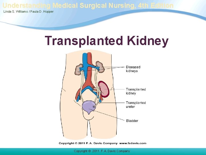 Understanding Medical Surgical Nursing, 4 th Edition Linda S. Williams / Paula D. Hopper Understanding Medical Surgical Nursing, 4 th Edition Linda S. Williams / Paula D. Hopper