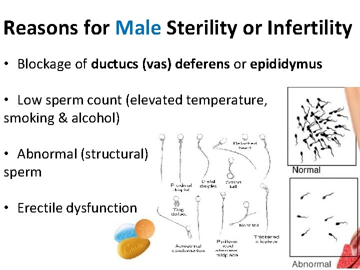 Reasons for Male Sterility or Infertility • Blockage of ductucs (vas) deferens or epididymus Reasons for Male Sterility or Infertility • Blockage of ductucs (vas) deferens or epididymus