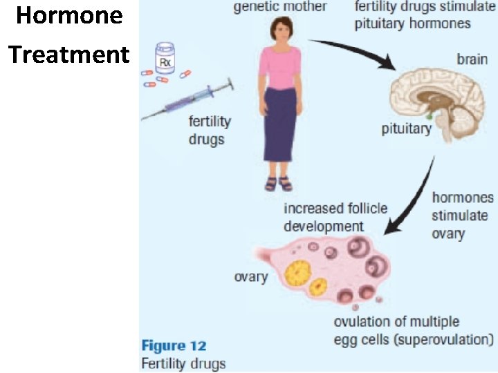 Hormone Treatment Hormone Treatment