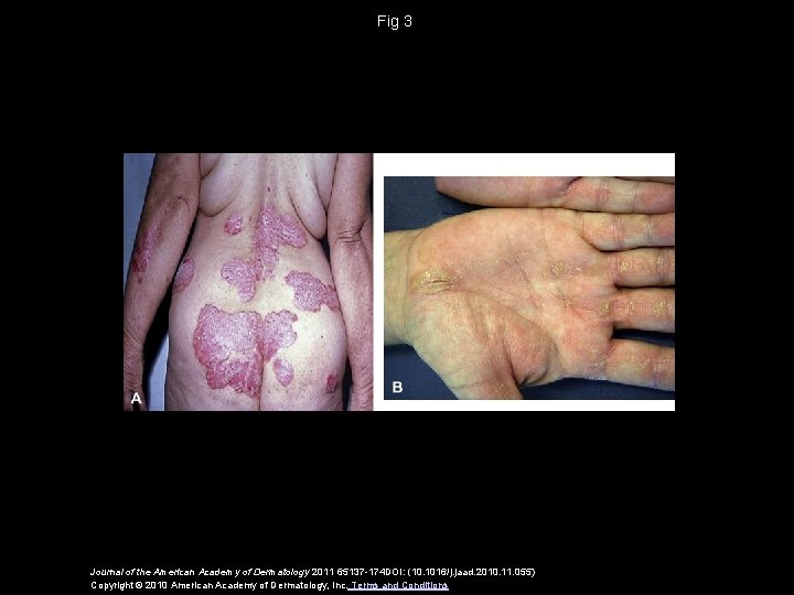 Fig 3 Journal of the American Academy of Dermatology 2011 65137 -174 DOI: (10.