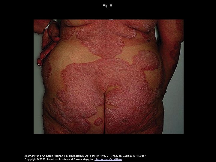 Fig 8 Journal of the American Academy of Dermatology 2011 65137 -174 DOI: (10.