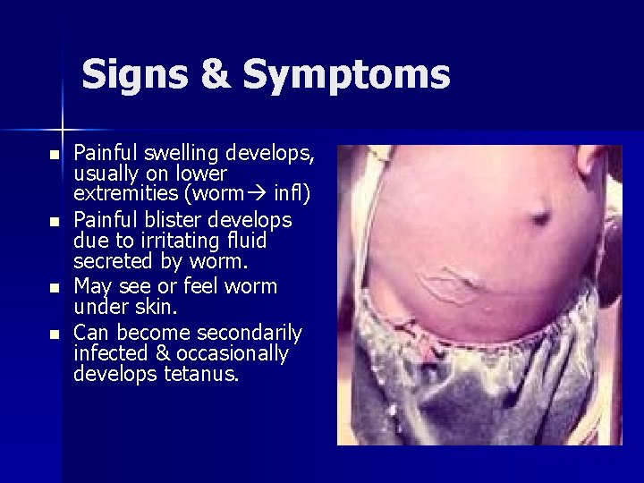 Signs & Symptoms n n Painful swelling develops, usually on lower extremities (worm infl)