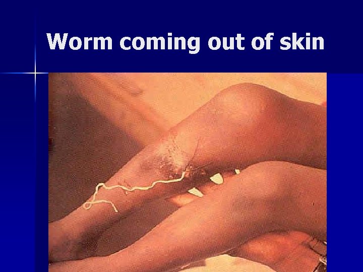 Worm coming out of skin 